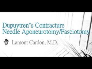 Dupuytren's Contracture Needle Aponeurotomy/Fasciotomy (Old)
