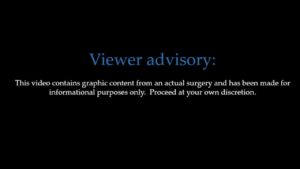 Subluxing Ulnar Nerve