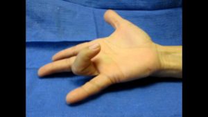 Trigger Finger Release